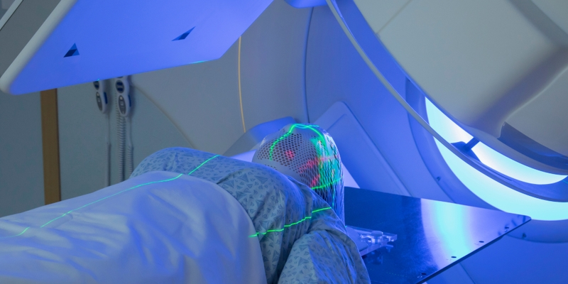 Xạ trị thường được chỉ định khi có thâm nhiễm hệ thần kinh trung ương (CNS)
