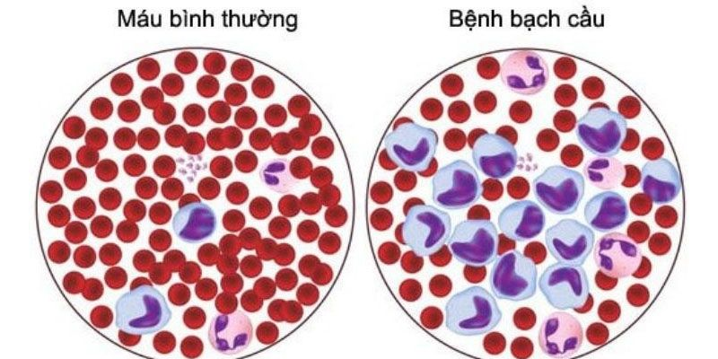 Các triệu chứng của bệnh bạch cầu tế bào tóc