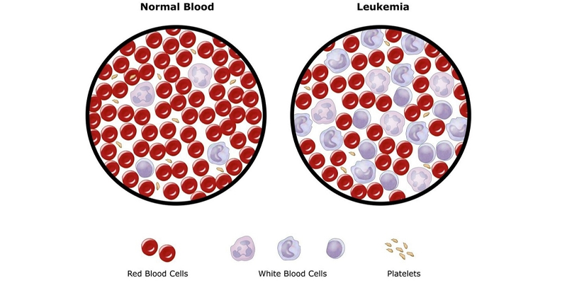Bệnh Leukemia là gì là thắc mắc của rất nhiều người