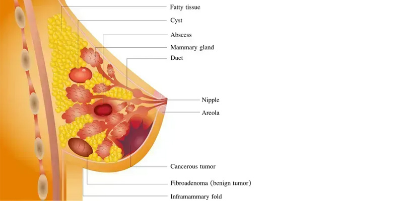 Ung thư vú ảy ra đột biến gen, làm cho tế bào tuyến vú mất đi sự kiểm soát
