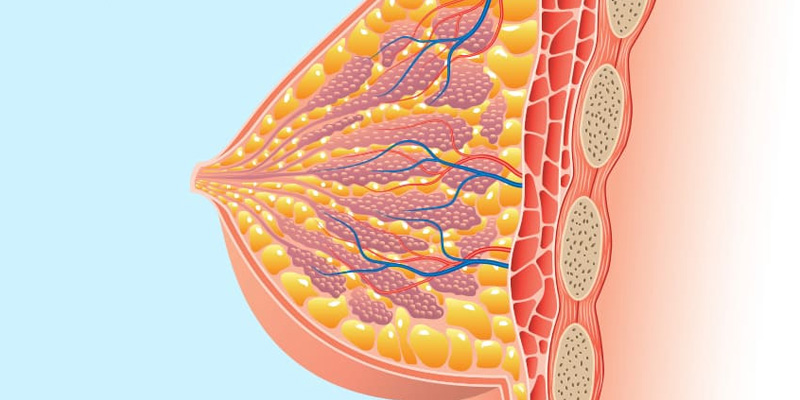 Mô vú dày đặc làm tăng nguy cơ ung thư vú