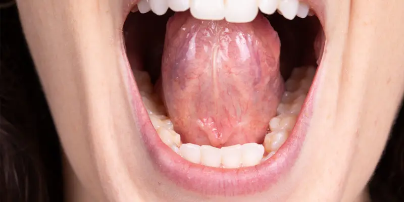 U nang dưới lưỡi thường có màu trắng hoặc hồng nhạt