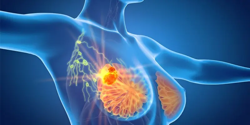 Ung thư biểu mô tuyến vú có nguy hiểm không