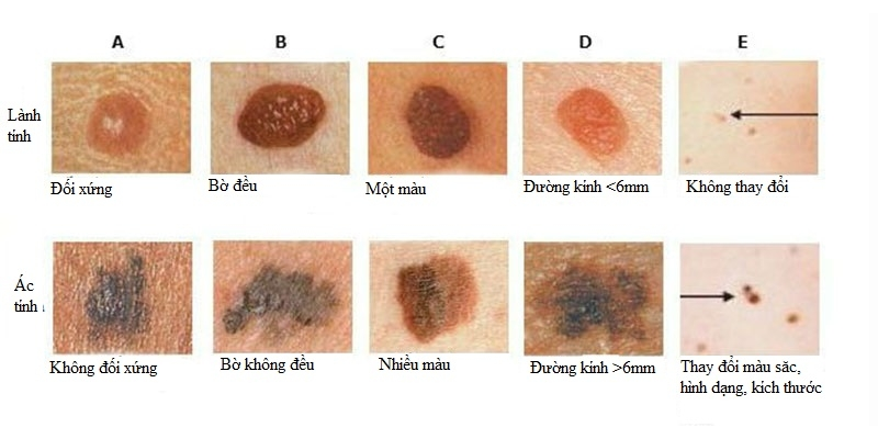 Ung thư da là gì? Có chữa được không?