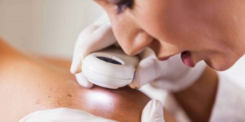 Bệnh nhân ung thư da có thể sống được bao lâu