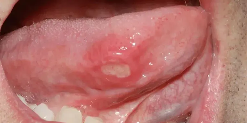 Ung thư lưỡi có di truyền không? Câu trả lời là không