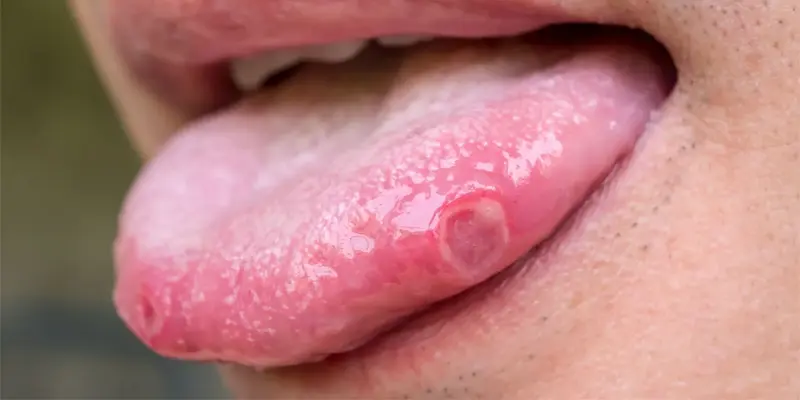 Bệnh ung thư lưỡi giai đoạn 2 có nguy hiểm không