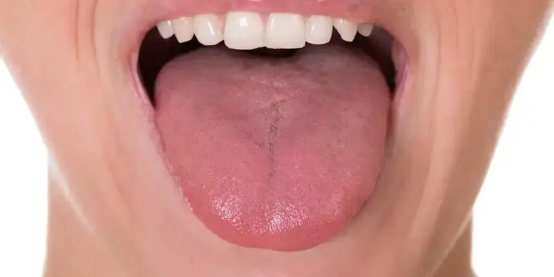 Ung thư lưỡi giai đoạn cuối sống được bao lâu