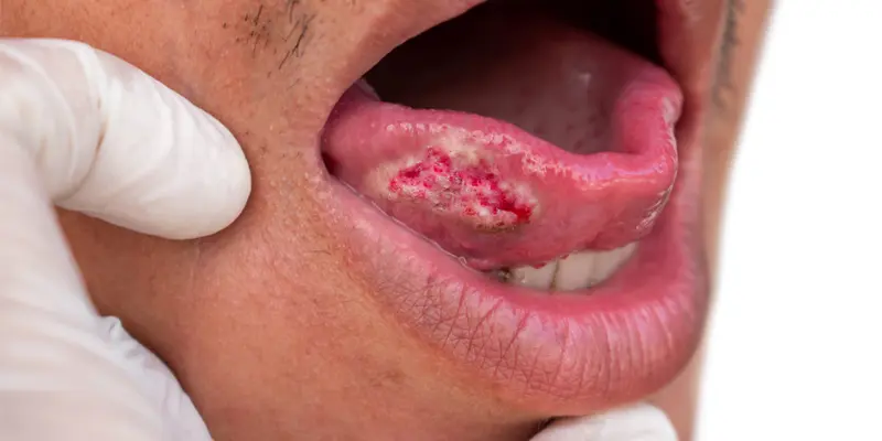 Ung thư lưỡi giai đoạn cuối hay còn gọi là ung thư lưỡi giai đoạn IV