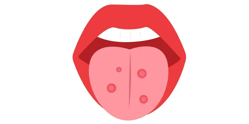 Ung thư lưỡi giai đoạn đầu có chữa được không