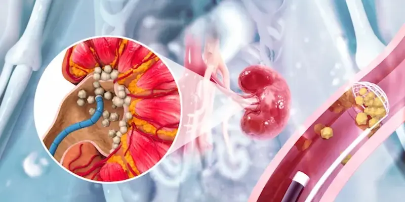 Bệnh ung thư niệu quản