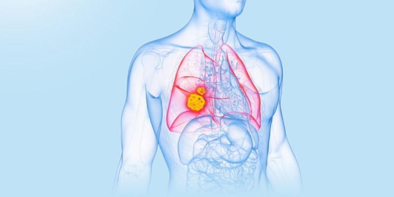 Ung thư phổi có chữa được không phụ thuộc vào nhiều yếu tố như thời điểm chẩn đoán, đặc điểm khối u, tổng trạng sức khỏe người bệnh,…