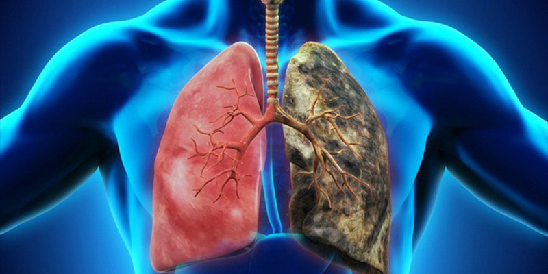 Ung thư phổi là căn bệnh nguy hiểm nhất hiện nay