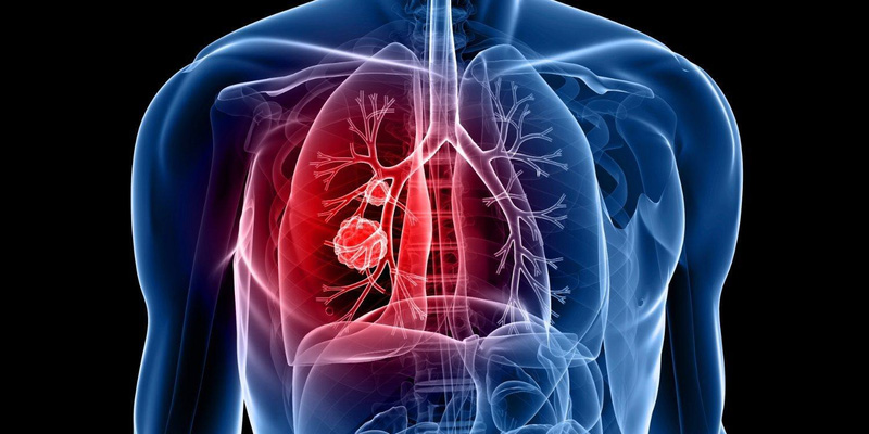 Bệnh ung thư phổi di căn có chữa được không