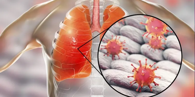 Bệnh ung thư phổi di căn gan có nguy hiểm không