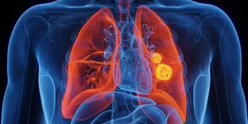 Bệnh ung thư phổi di căn não là gì