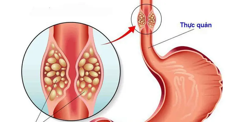 Ung thư thực quản