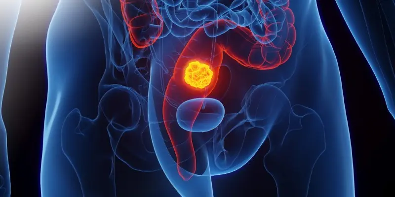 Ung thư trực tàng