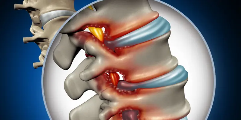 Bệnh ung thư tủy sống