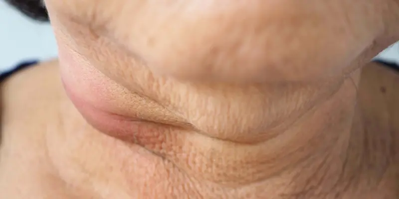 Ung thư tuyến giáp giai đoạn 2 là tình trạng khối u phát triển lớn từ 2 – 4 cm