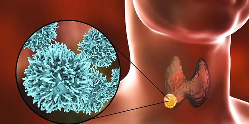 Ung thư tuyến giáp thể nhú có nguy hiểm không
