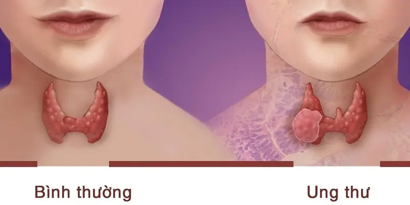 Ung thư tuyến giáp thể tủy là một dạng ung thư hiếm gặp nhưng vo cùng nguy hiểm