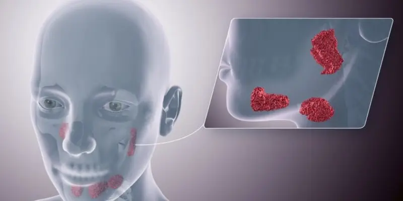 Ung thư tuyến nước bọt do xuất hiện các khối tăng sinh ác tính tại 1 trong 3 cặp tuyến