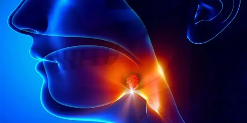 Ung thư vòm họng giai đoạn 3 là khi các tế bào u đã xâm lấn sang các cơ quan xung quanh