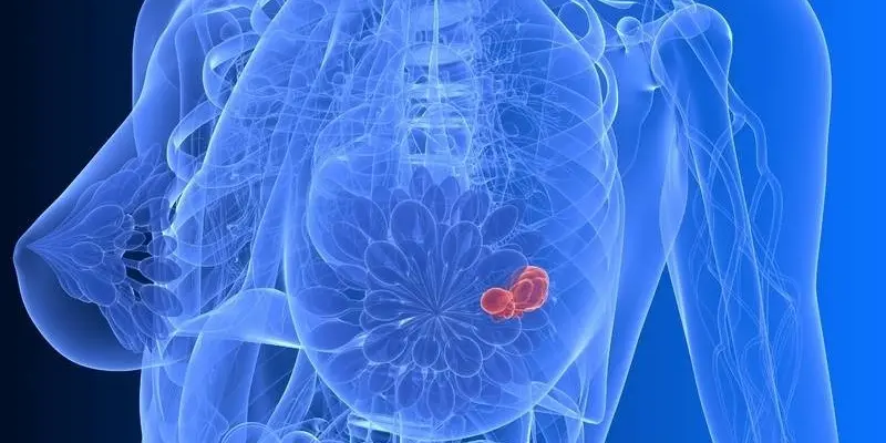 Bệnh ung thư vú có di truyền không?