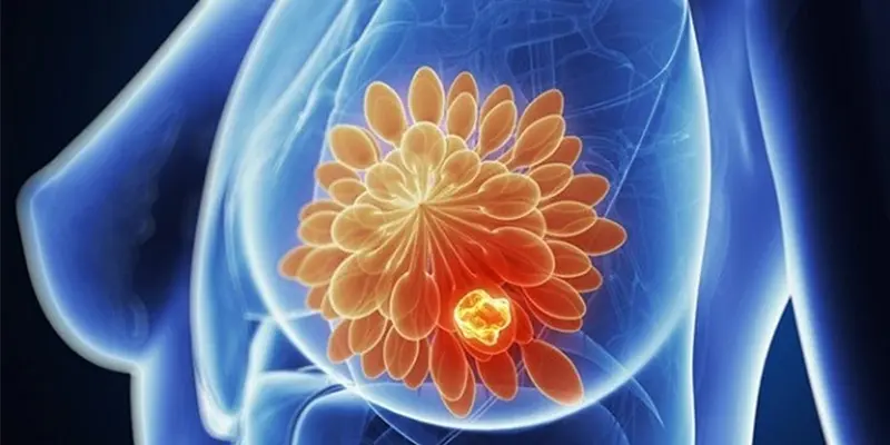 Ung thư vú có lây không?