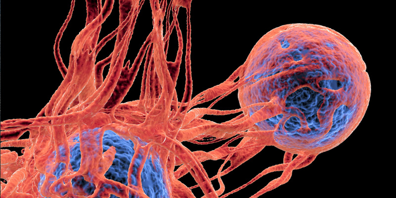 Mô phỏng ung thư vú di căn đến xương - giai đoạn cần được can thiệp đúng cách