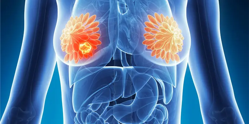 Ung thư vú di căn xương sống được bao lâu?