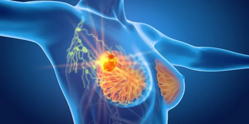 Ung thư vú là loại ung thư phổ biến nhất ở phụ nữ