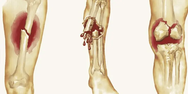 Bệnh ung thư xương