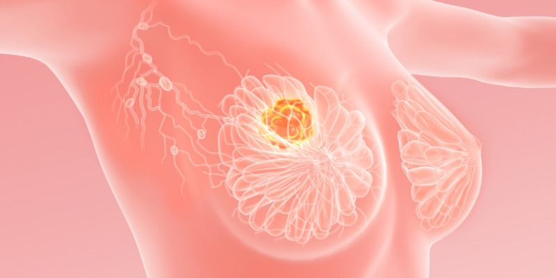 U vú lành tính có nên mổ không và câu trả lời