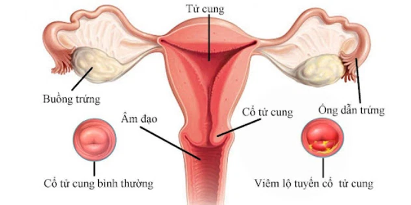 Hình ảnh giải phẫu hệ sinh dục nữ, cổ tử cung là vùng màu xanh da trời