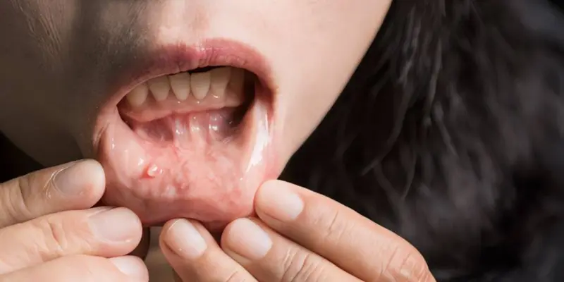 Bị ung thư khoang miệng sống được bao lâu phụ thuộc vào thời điểm phát hiện bệnh