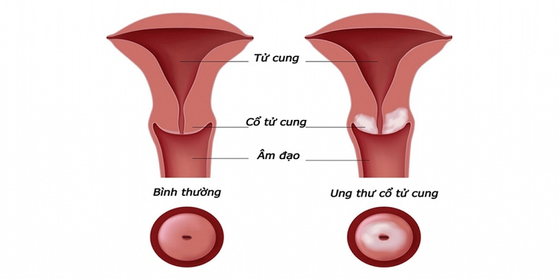 Ung thư cổ tử cung di căn, thông thường, bắt đầu từ cuối giai đoạn 2