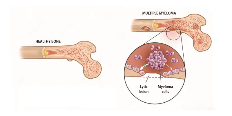 Đa u tủy xương Myeloma