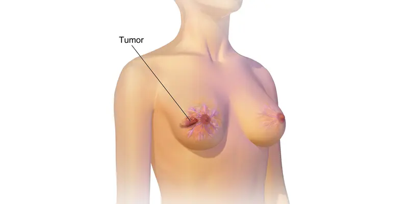 Nếu thấy vú có khối u cứng thì nên đến bệnh viện khám tầm soát ung thư vì đây có thể là biểu hiện ung thư vú