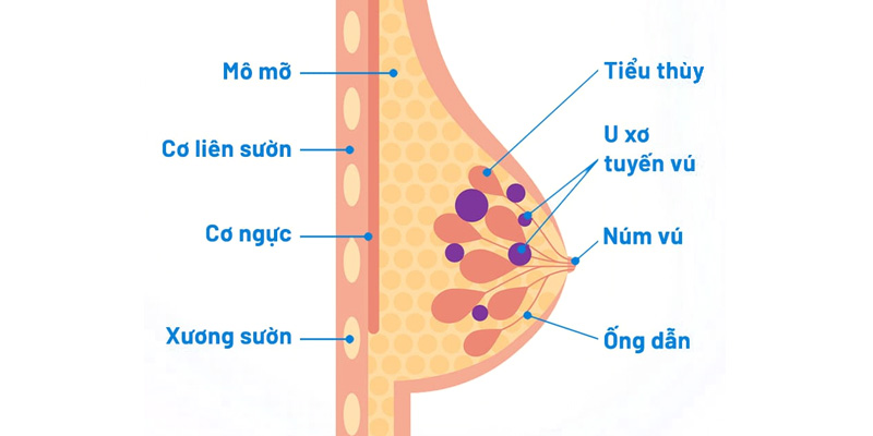 Bướu sợi tuyến vú hay còn gọi là u xơ tuyến vú
