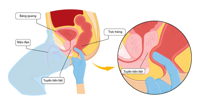 Các biện pháp chẩn đoán ung thư tuyến tiền liệt