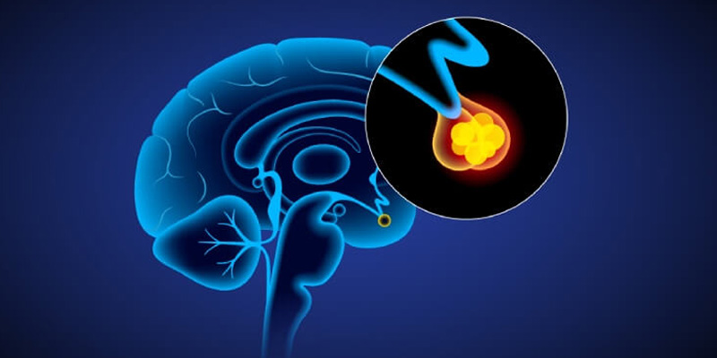 Các dạng đươc ưu tiên phẩu thuật ung thư não