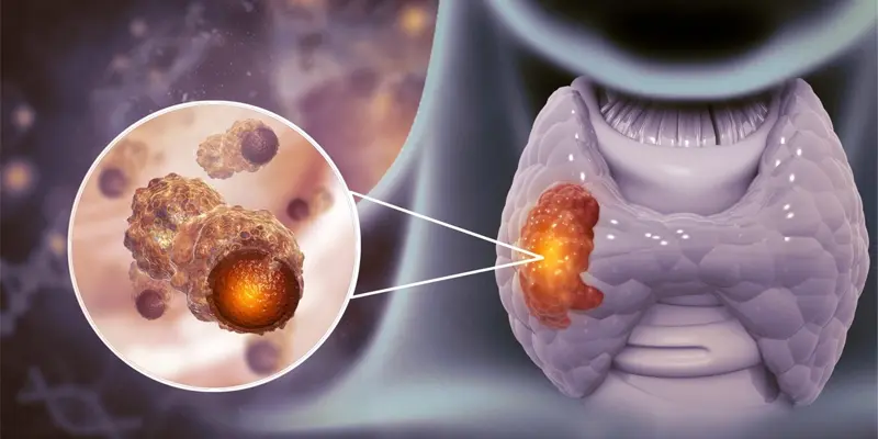 Ung thư tuyến giáp thể biệt hóa có hai dạng