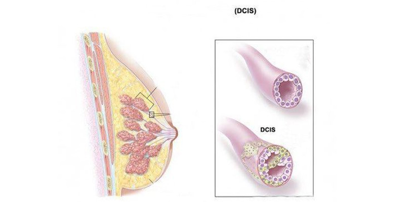 Hình ảnh ung thư biểu mô ống tại chỗ (DCIS)