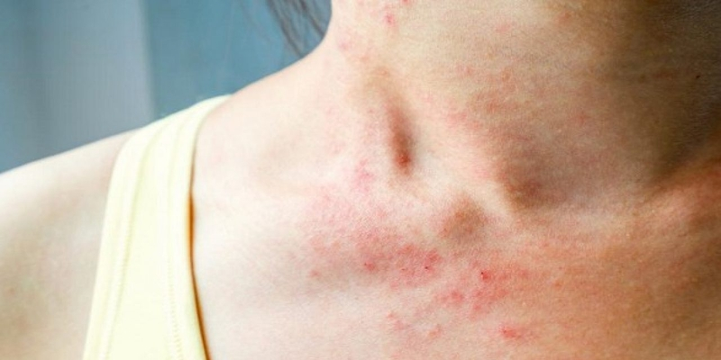 Xuất hiện các đốm đỏ hoặc tím trên da là dấu hiệu ung thư máu