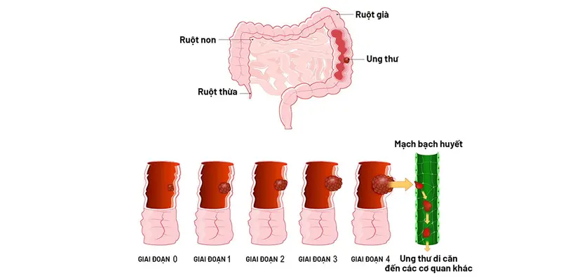 Các giai đoạn hình thành của ung thư đại tràng