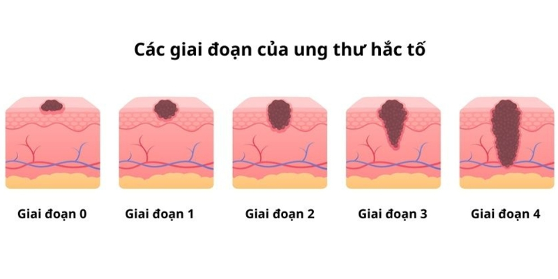 Hệ thống TNM giúp phân loại các giai đoạn của ung thư hắc tố.
