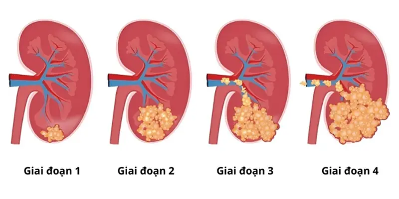 Ung thư thận giai đoạn đầu có khối u nhỏ, chỉ khu trú bên trong thận.