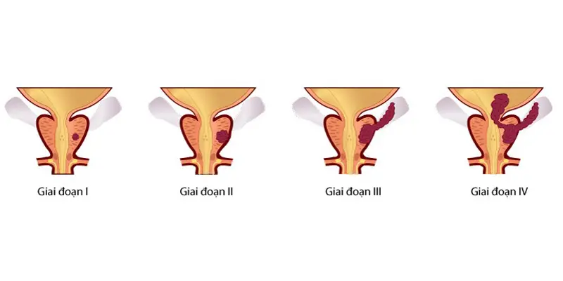 Các giai đoạn của ung thư tuyến tiền liệt